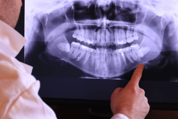 Best Emergency Wisdom Teeth Removal in Lakeport, TX